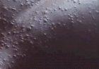 Benue probes suspected Mpox outbreak as Korinya residents cry for urgent medical intervention