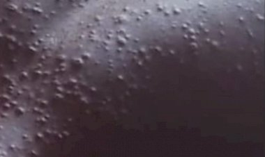 Benue debunks Mpox outbreak rumours in Konshisha, says cases were chickenpox