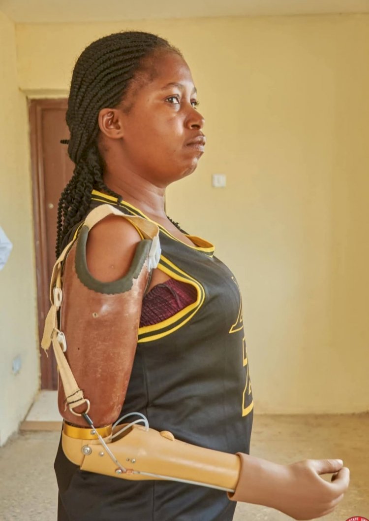 Hope restored in Makurdi: BSUTH fits first prosthetic arm on armed herdsmen attack survivor